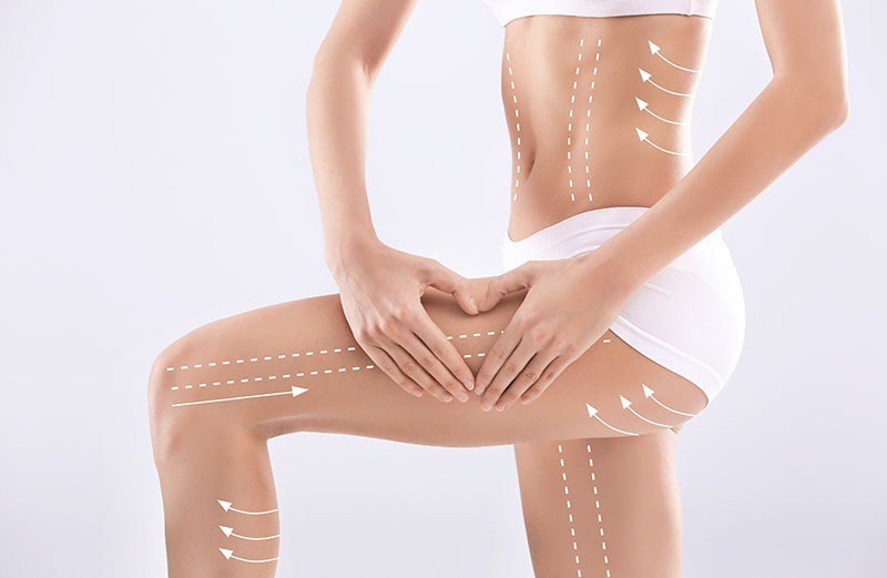 Markierte Körperzonen für QuickLipo: Bauch, Hüfte und Oberschenkel als typische Behandlungsbereiche